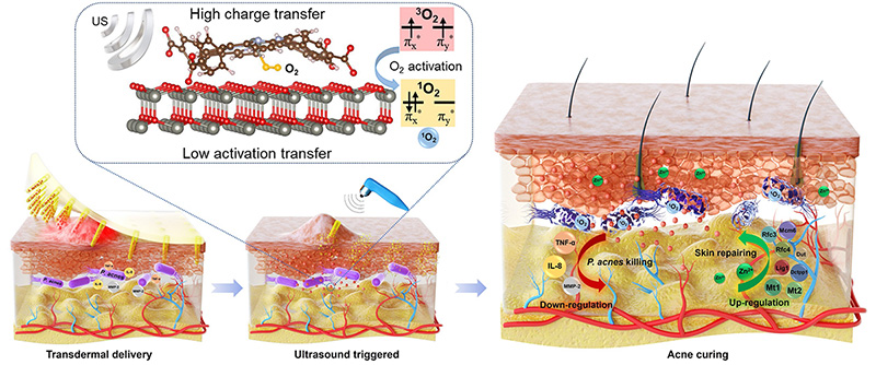 מיקרו-מחטים המופעלות באולטרסאונד עם ננו-חלקיקים אנטיבקטריאליים לזיהומי עור
